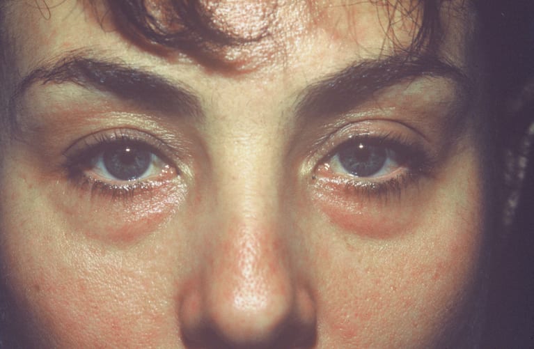 Before & After Gallery - Eyelid Surgery Case 8-3 by ...