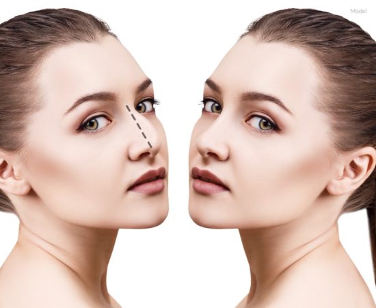 Concept of a woman before and after her rhinoplasty surgery.