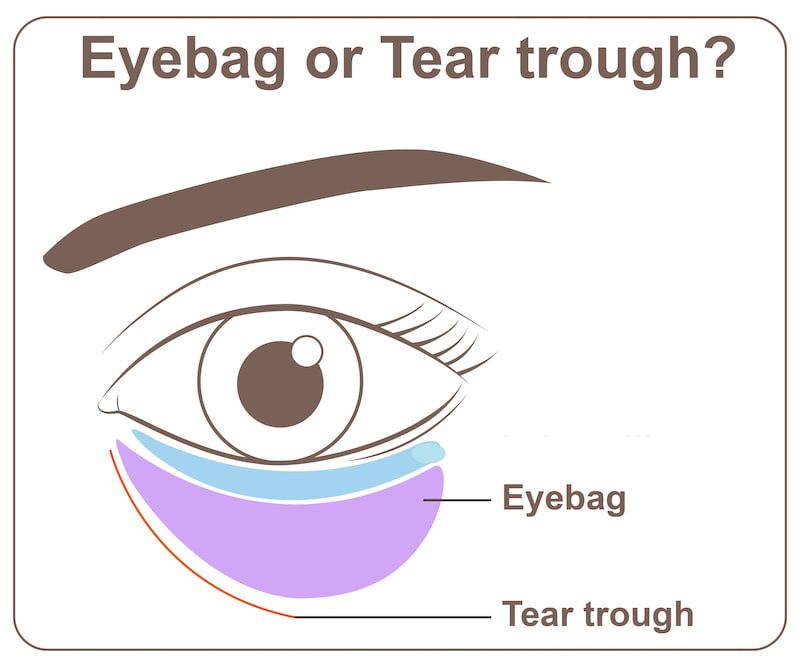 Illustration of a eye with notes for the eyebag and tear trough