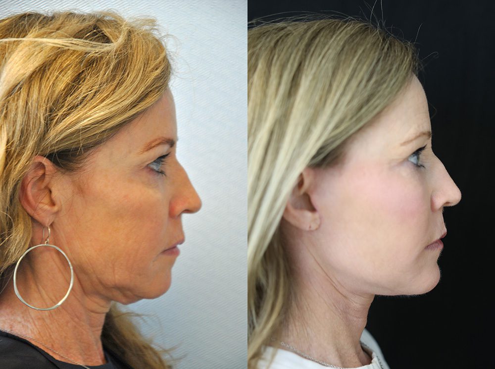 Actual Patient Results