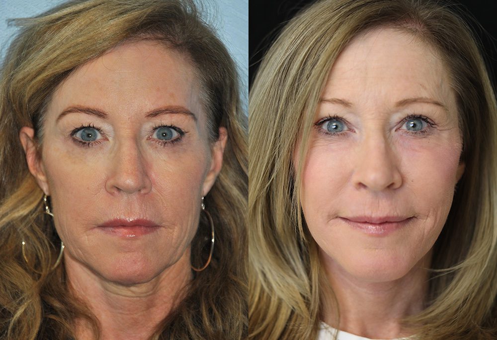 Actual Patient Results 2