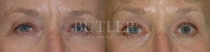 Brow Lift Before and After Patient Thumbnail 1