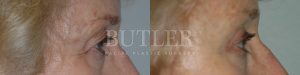 Brow Lift Before and After Patient Thumbnail 2