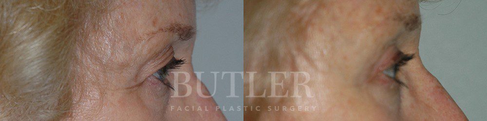Brow Lift Before and After Patient 2
