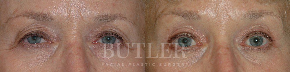 Brow Lift Before and After Patient 1