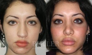 Facial Implants Before and After Patient Thumbnail 1