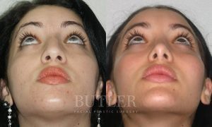 Facial Implants Before and After Patient Thumbnail 2