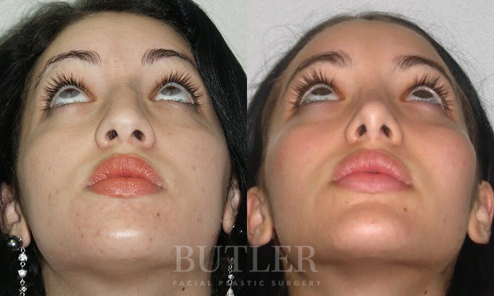 Facial Implants Before and After Patient 2