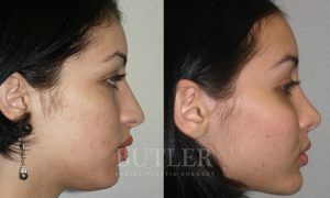 Facial Implants Before and After Patient Thumbnail 3