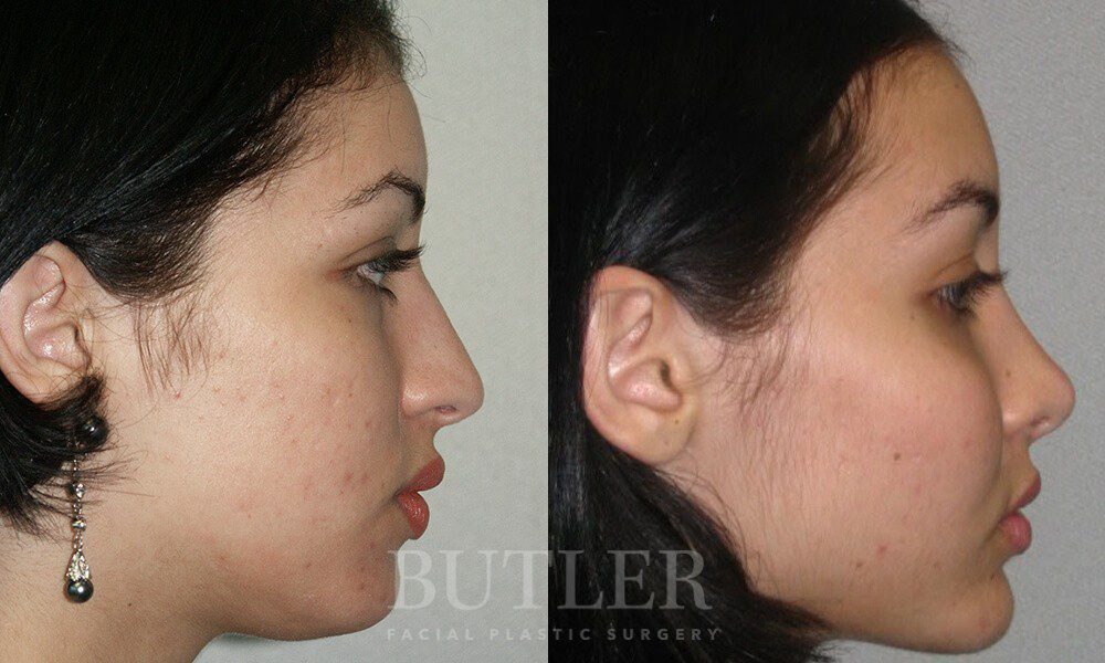 Facial Implants Before and After Patient 3