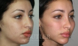 Facial Implants Before and After Patient Thumbnail 4