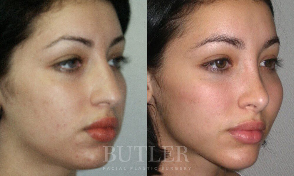 Facial Implants Before and After Patient 4