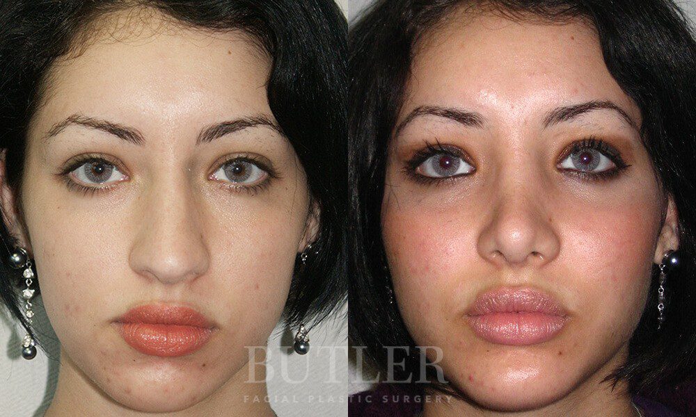 Facial Implants Before and After Patient 1