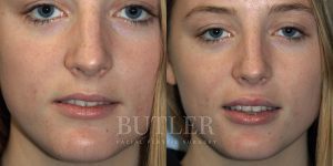 Lip Augmentation Before and After Patient Thumbnail 1