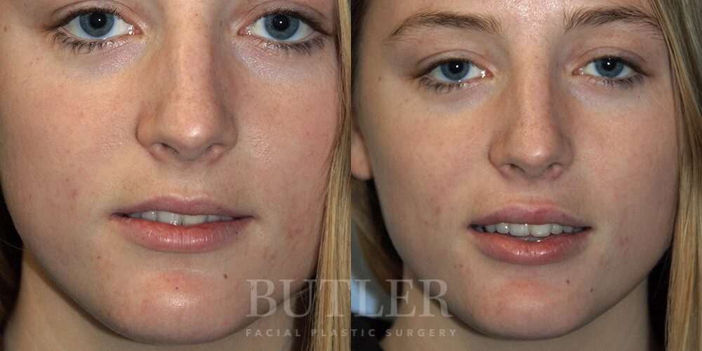 Lip Augmentation Before and After Patient 1