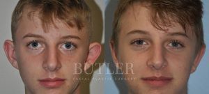 Otoplasty Before and After Patient Thumbnail 1