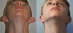 Otoplasty Before and After Patient Thumbnail 2