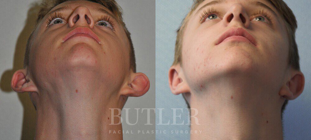 Otoplasty Before and After Patient 2