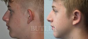 Otoplasty Before and After Patient Thumbnail 3