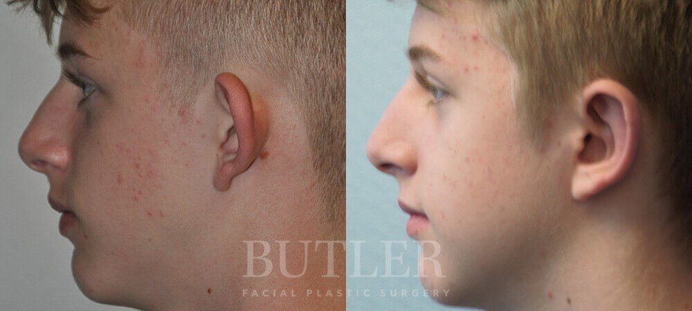Otoplasty Before and After Patient 3