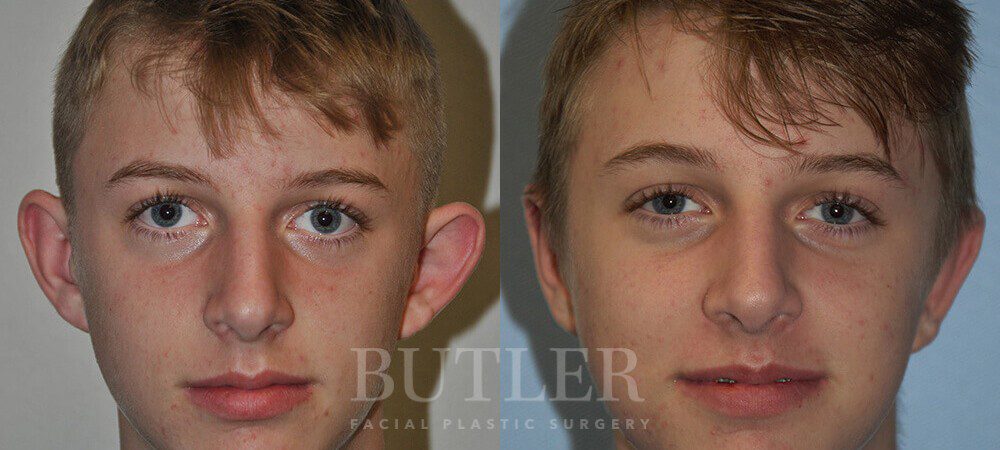 Otoplasty Before and After Patient 1
