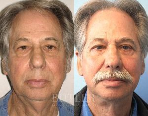 Facelift Before and After Patient Thumbnail 1