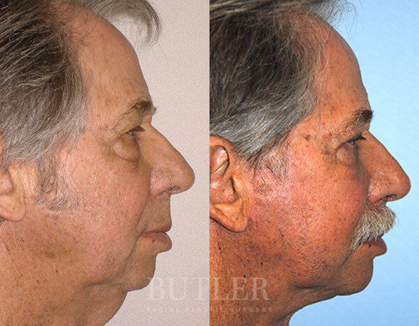 Facelift Before and After Patient 3