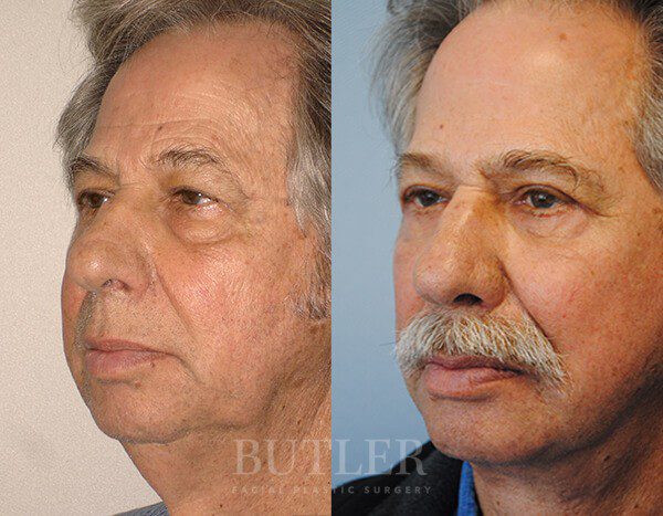 Facelift Before and After Patient 2