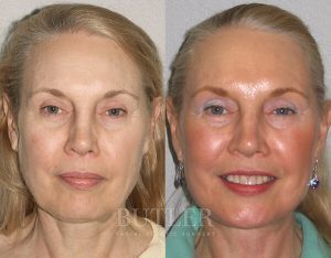 Facelift Before and After Patient Thumbnail 1