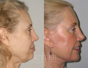 Facelift Before and After Patient Thumbnail 3