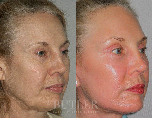 Facelift Before and After Patient 2