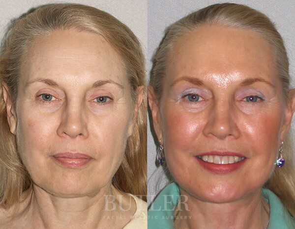 Facelift Before and After Patient 1