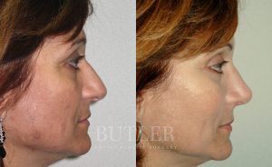 Mid-Facelift Before and After Patient Thumbnail 3