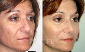 Mid-Facelift Before and After Patient Thumbnail 2