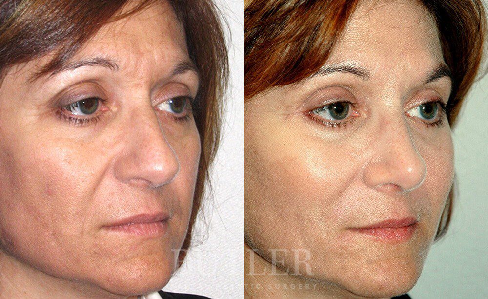 Mid-Facelift Before and After Patient 2