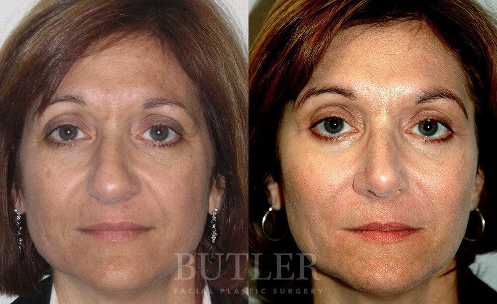 Mid-Facelift Before and After Patient 1