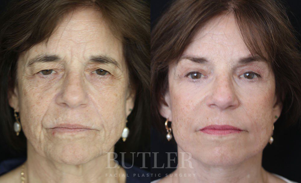 Neck Lift Before and After Patient 1