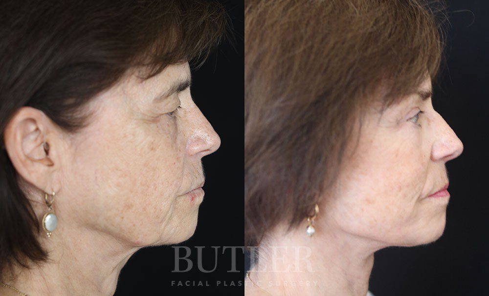 Neck Lift Before and After Patient 2