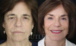 Neck Lift Before and After Patient Thumbnail 3