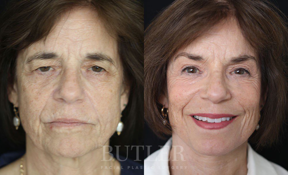 Neck Lift Before and After Patient 3
