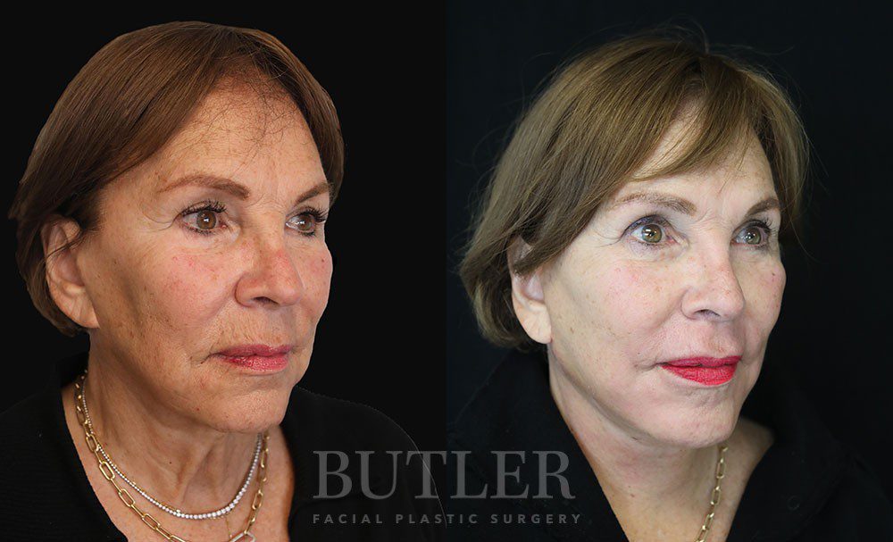 Facelift Before and After Patient 1