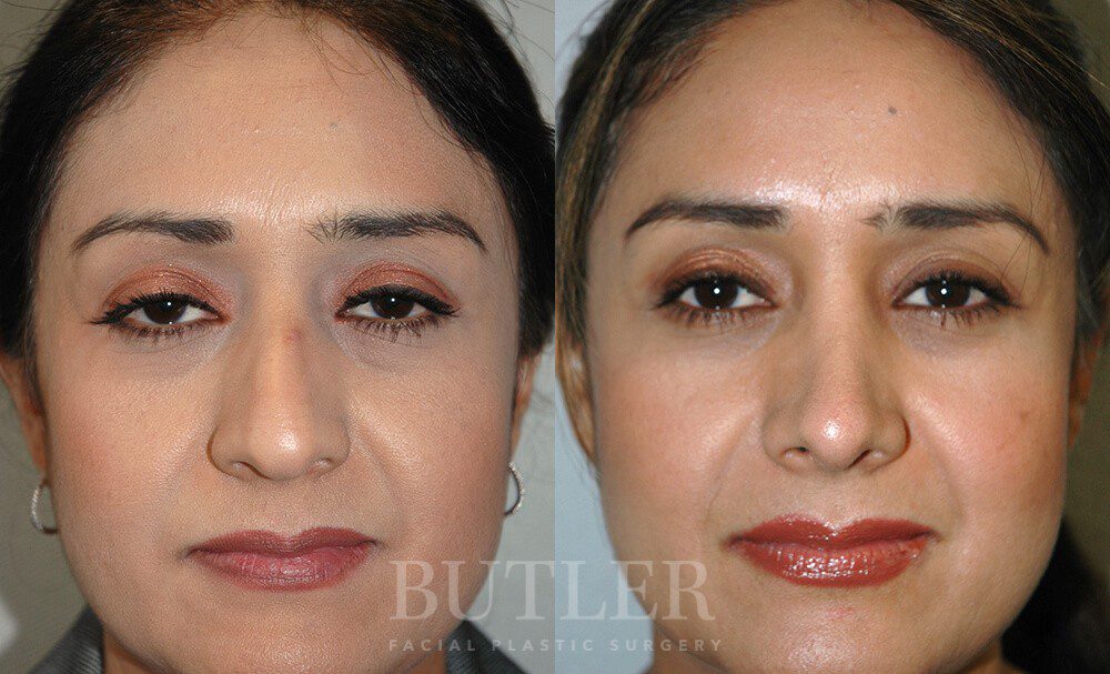 Rhinoplasty Before and After Patient 1