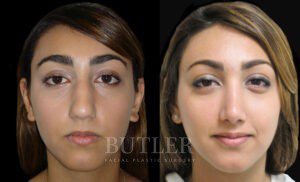 Rhinoplasty Before and After Patient Thumbnail 1