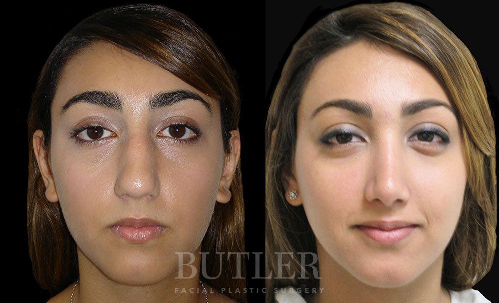 Rhinoplasty Before and After Patient 1
