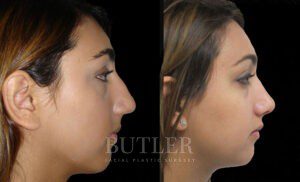 Rhinoplasty Before and After Patient Thumbnail 2