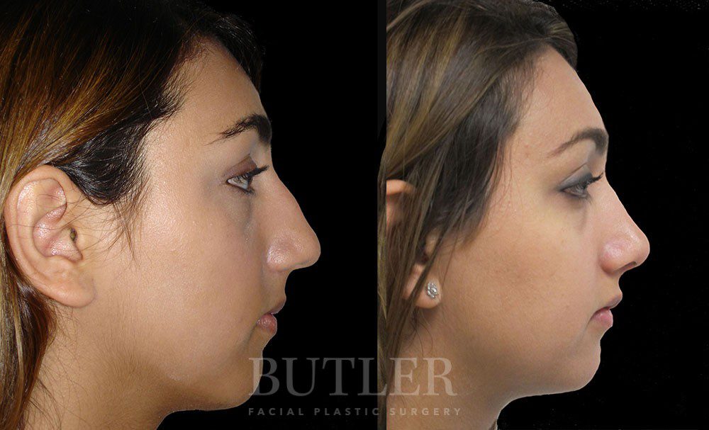 Rhinoplasty Before and After Patient 2