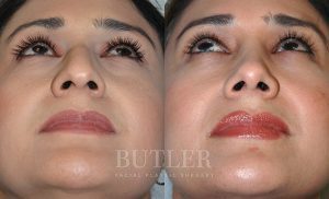 Rhinoplasty Before and After Patient Thumbnail 2