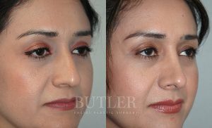 Rhinoplasty Before and After Patient Thumbnail 3