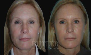 Facelift Before and After Patient Thumbnail 1