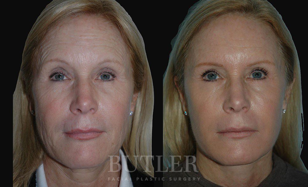 Facelift Before and After Patient 1